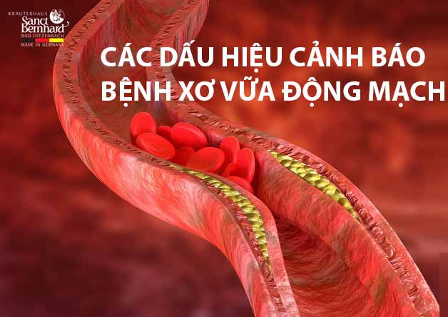 Dấu hiệu cảnh báo bệnh xơ vữa động mạch bạn cần biết